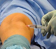 Foto Kniearthrose Stammzellenbehandlung